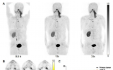 JNM|新型环肽放射性探针68Ga-FAP-2286在多种实体瘤中的PET/CT显像研究