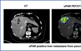 新型PET示踪剂显示神经内分泌肿瘤uPAR靶向治疗的前景