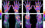 超低剂量全身PET/CT可有效评估关节炎
