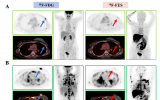 Palbociclib联合内分泌治疗的乳腺癌候选患者或将受益