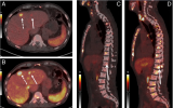 揭秘极光PET/CT，Biograph Vision Quadra PSMA + FDG 双显像新探索