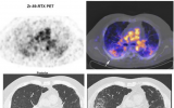 Immuno-PET预测患者对利妥昔单抗治疗的反应