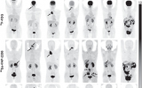 新型PET放射性示踪剂成功检测出多种癌症，为新的靶向放射性核素治疗提供了潜力