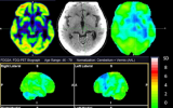 PET有望诊断非典型帕金森综合征